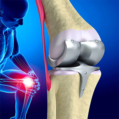 Contact Dr. Dhruv Patel for Knee Joint Replacement Surgery Specialist in Navi Mumbai, Vashi & Belapur